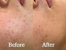 シーベル 小倉/症例写真/ハーブピーリング