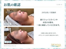 モアナ(MOANA)/【小顔/たるみ】インモード