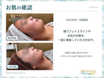モアナ(MOANA)/【小顔/たるみ】インモード