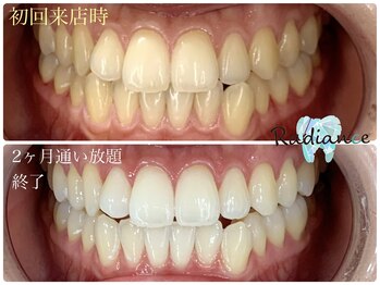 札幌セルフホワイトニング ラディアンス(Radiance)/ホワイトニング