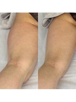 リリー(Lily)/気になる側面も撃退!