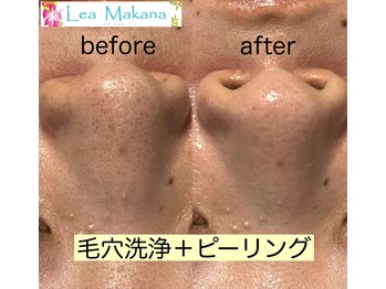 レアマカナ(LeaMakana)/毛穴洗浄+ピーリング
