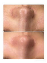 ヘラ(HERA)/鼻の黒ずみ角栓除去お任せ下さい