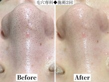 フレイヤ(FREYA)/毛穴専科Before→After