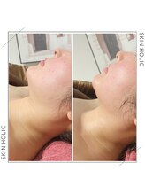 スキンホリック 恵比寿駅前店(SKIN HOLIC)/フェイスラインもスッキリ！