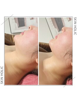スキンホリック 恵比寿駅前店(SKIN HOLIC)/フェイスラインもスッキリ！