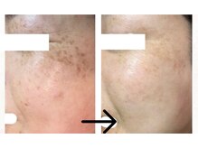 コトハ(cottha)/シミケア