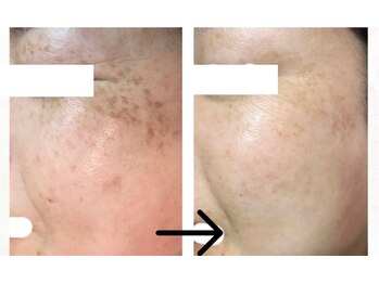 コトハ(cottha)/シミケア