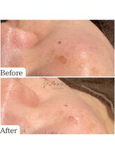 サロン ウーカ(salon WOOCA)/シミケアペン【シミ】