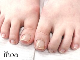 巻き爪　巻き爪補正　フットケア