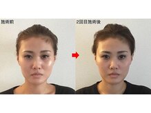 整体院プラス/小顔矯正モニター