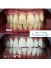 ホワイトニングサロン 熊本店/簡単ホワイトニング