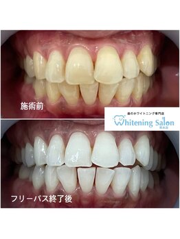 ホワイトニングサロン 熊本店/簡単ホワイトニング