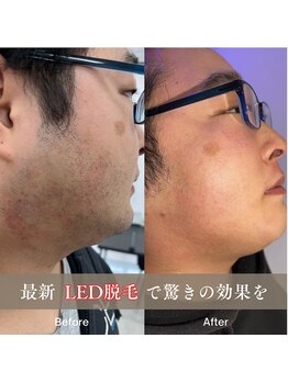 カラー(COLOR)/最新LED脱毛機導入!!