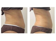 ラディア ボディ(Radia Body)/痩身マシン＋リンパ