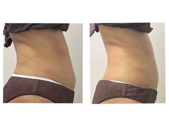 ラディア ボディ(Radia Body)/痩身マシン＋リンパ