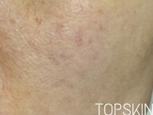 トップスキン 表参道(TOPSKIN)/専門家開発☆TOPSKINの肌質改善