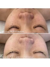 ミエル 神戸店(Miel)/タラソトリートメントで白さUP