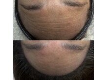 ウィンウィン 新山口店(Win Win)/おでこのシワもさよなら