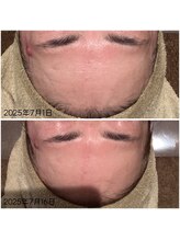 サロン リア(Salon Li’a)/1回でのビフォーアフター☆