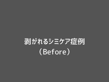 オアシスラグーン(OASIS LAGOON)/剥がれる!!シミのポイントケア