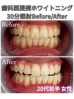 プラチナムビューティ 四条烏丸店(PLATINUM Beauty)/ホワイトニング!Before./After!