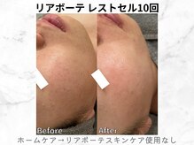 リライン(ReLine)/【レストセル　10回】