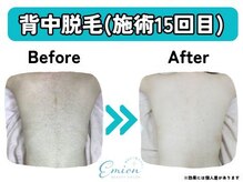 エミオン(Emion)/《背中脱毛 Before→After》