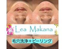 レアマカナ(LeaMakana)/毛穴洗浄＋ピーリング＋パック