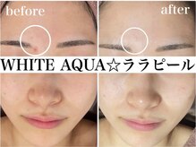 ホワイトアクア 錦糸町店(WHITE AQUA)/ララピール/毛穴/東京/錦糸町