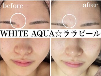 ホワイトアクア 錦糸町店(WHITE AQUA)/ララピール/毛穴/東京/錦糸町