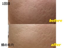 リボーン(be reborn)/頬の毛穴