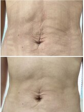 リクラ 北千住(Reclat)/1回のインディバのお腹コース