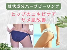 プライベートエステサロン トゥインクル/ヒップのニキビケア・黒ずみ改善