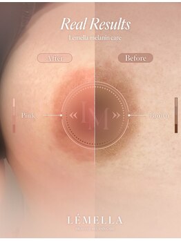 キレイバスト(Kireiii Bust)/ビフォーアフター