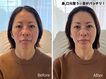 ミラ 中央林間(mira)/小顔 毛穴 ほうれい線 ハリ弾力
