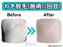 エミオン(Emion)/《わき脱毛 Before→After》