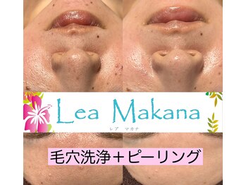 レアマカナ(LeaMakana)/毛穴洗浄+ピーリング+パック