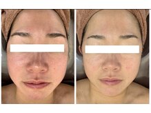 アンパス(Unpas)/無添加セルディナ化粧品肌質改善