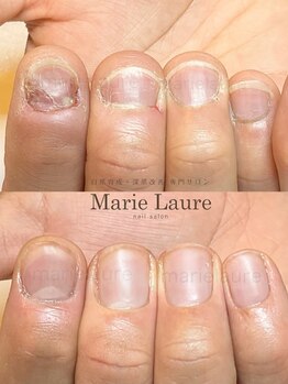 マリーロール 天王寺店(Marie Laure)/深爪矯正/自爪育成/ネイルケア/