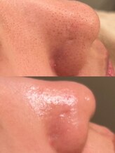 【毛穴レス肌デトックスコース後】※拡大してご覧ください。