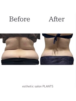 プランツ(PLANTS)/40代／８回（１ヶ月）／お腹ケア