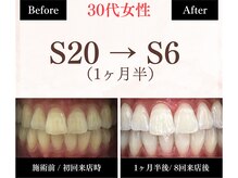 ホワイトニングセンター 長野駅前店/【長野市ホワイトニング】