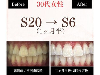 ホワイトニングセンター 長野駅前店/【長野市ホワイトニング】