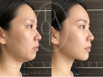 多穏スキンケア(skin care)/【人気No.1】ヴィショットV-shot