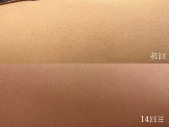 ウォーム(warm)/脱毛/顔脱毛/シェービング