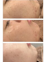 トゥモロー(TOMORROW)/ハーブピーリング/肌質改善