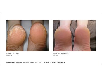 ウル(Ulu)/かかとピールトリートメント★