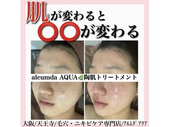 アルムダアクア 天王寺店(Aleumda AQUA)/毛穴エクストラクションプロ大阪