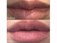 アールメディカルサロン 富山院(R Medical Salon)/ローマピンク／唇